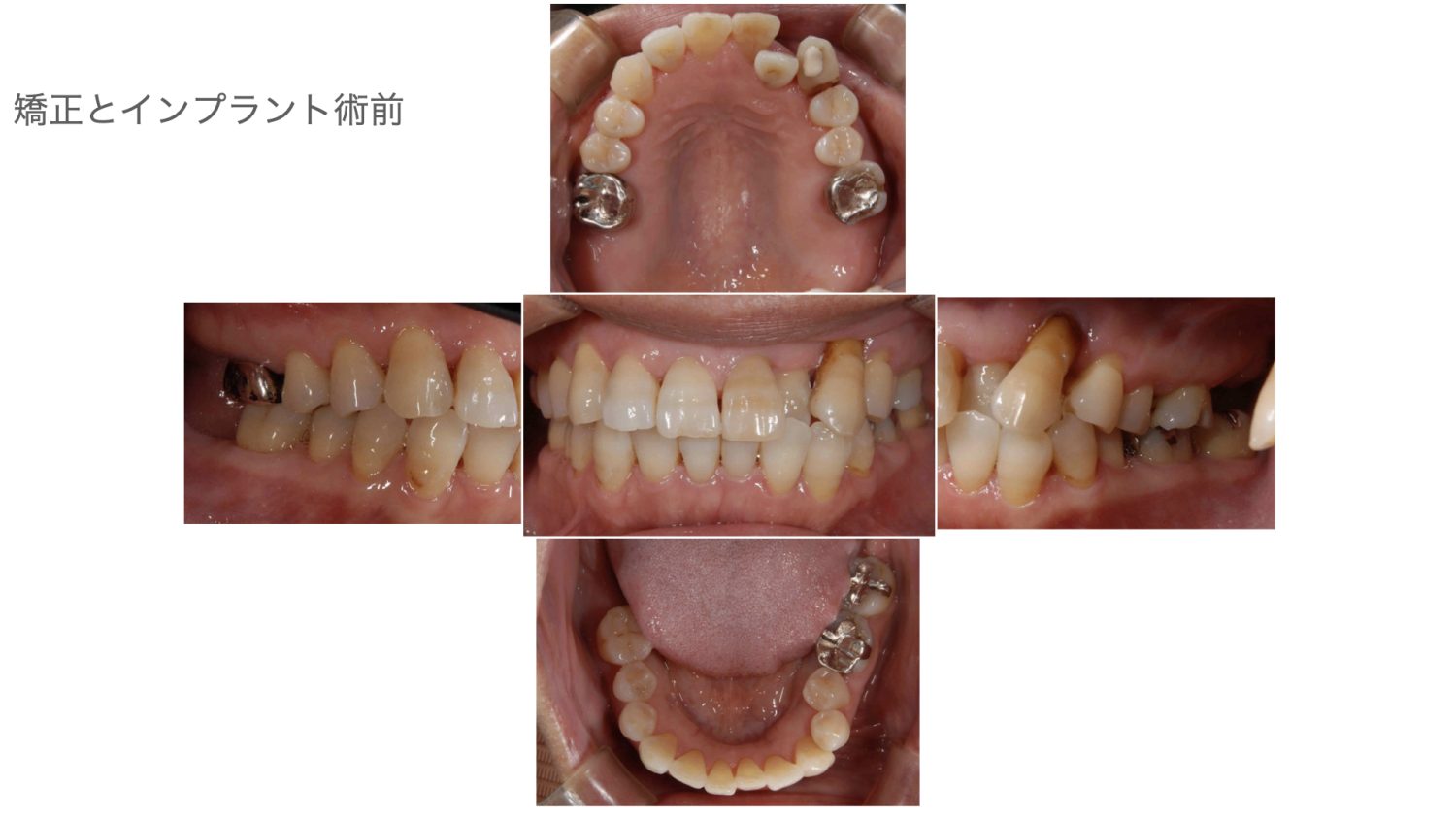 おぎの歯科医院 インプラント治療・矯正治療 before