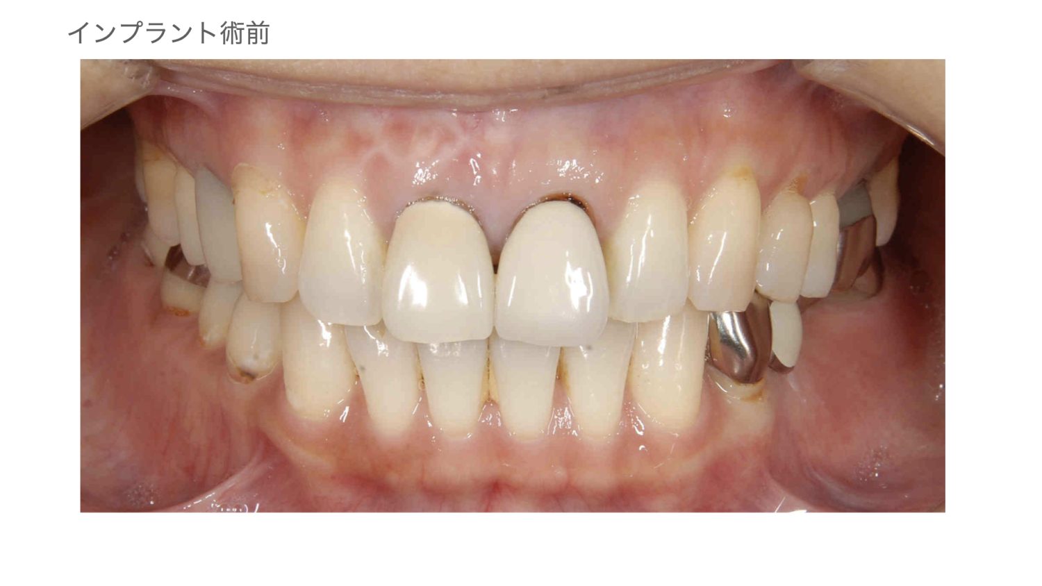 おぎの歯科医院 インプラント治療・セラミック治療③ before