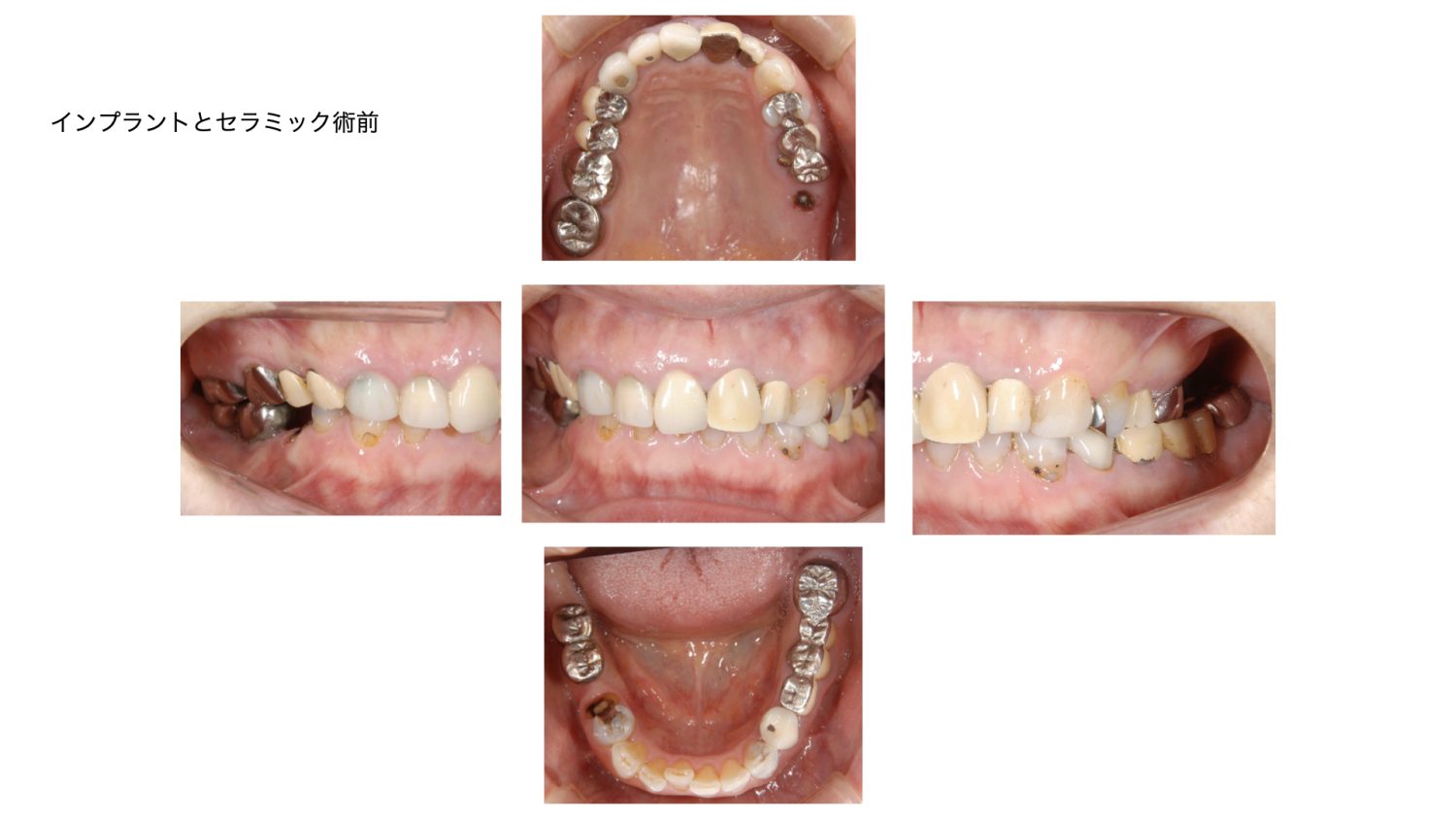 おぎの歯科医院 インプラント治療・セラミック治療④ before