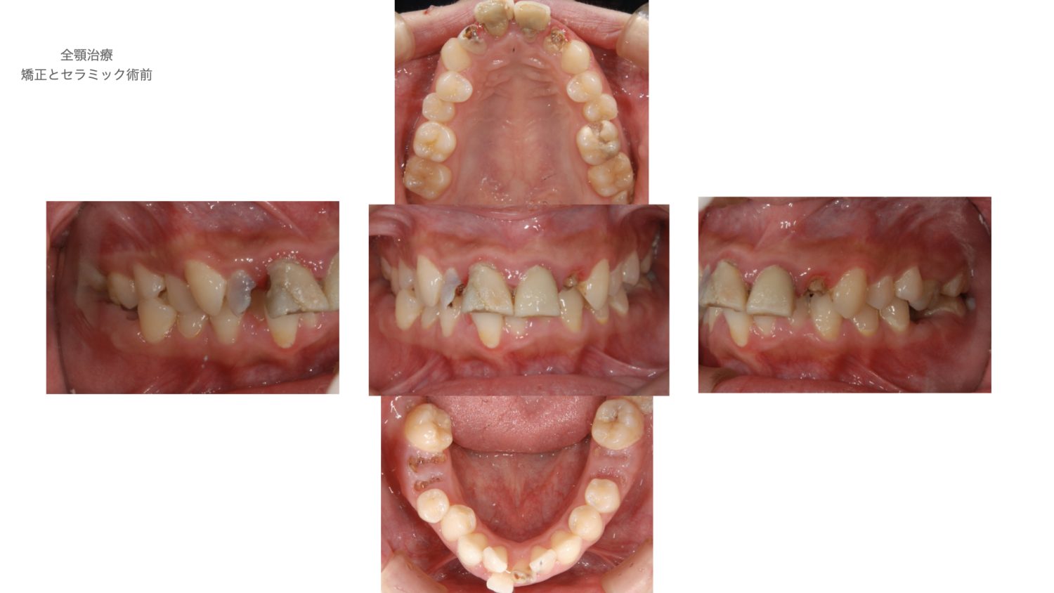 おぎの歯科医院 根管治療・矯正治療・補綴治療 before