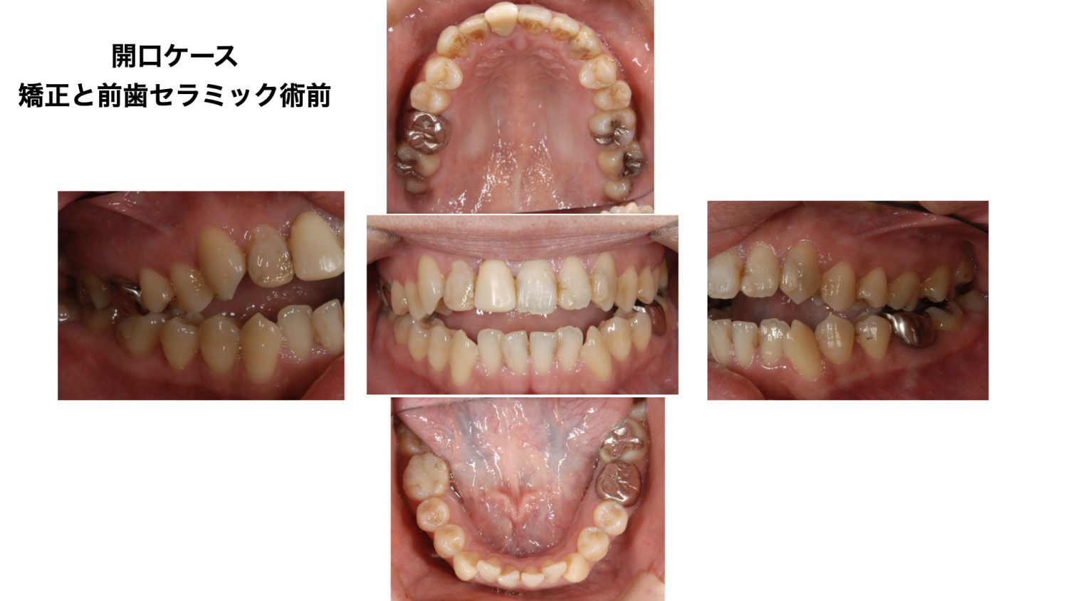 おぎの歯科医院 矯正治療・審美治療の症例紹介 before