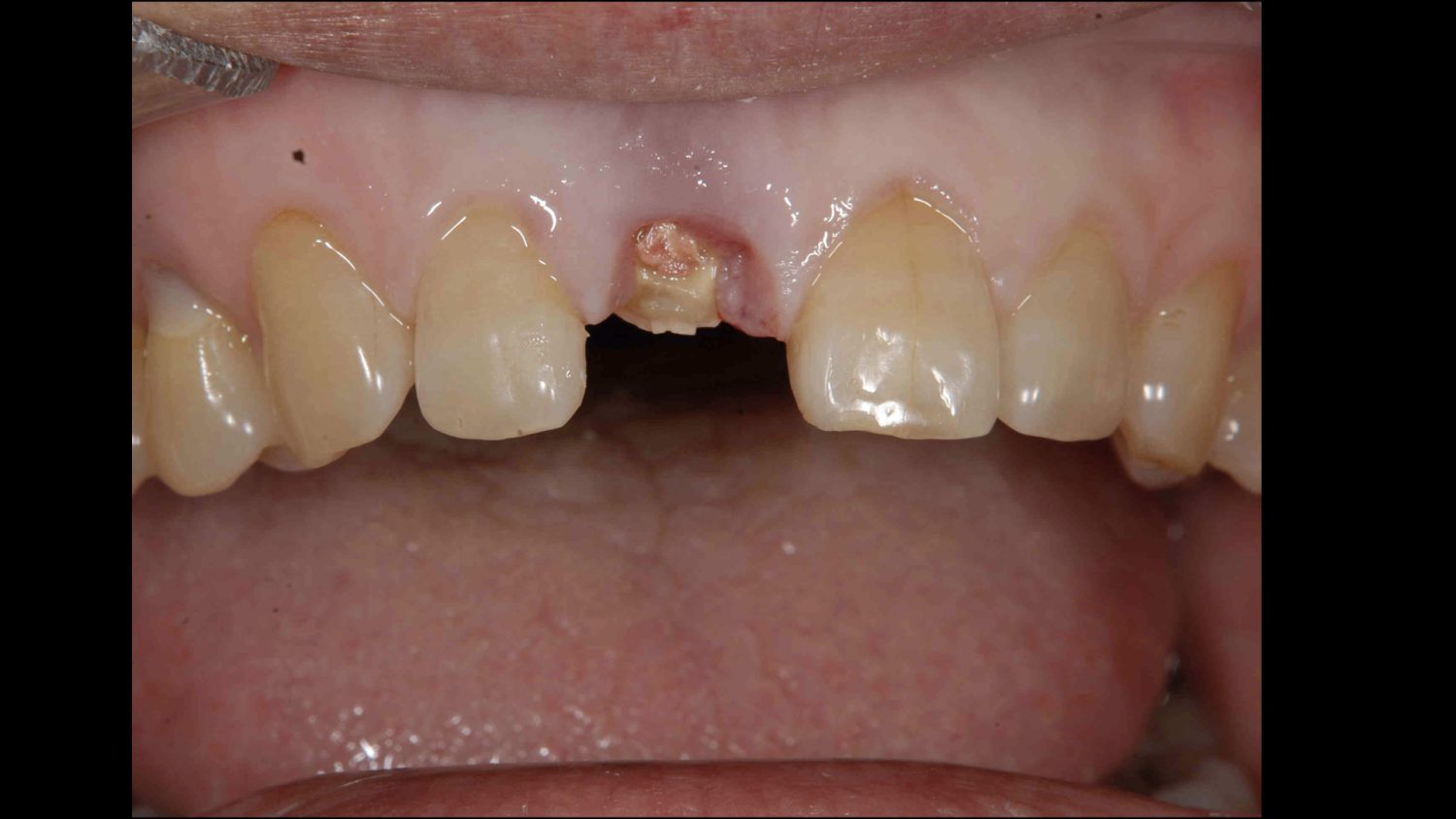 おぎの歯科医院 インプラント治療① before