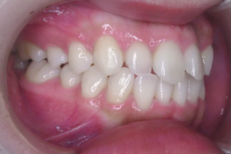 ひまわり歯科矯正歯科 全顎矯正⑥ before 右側面