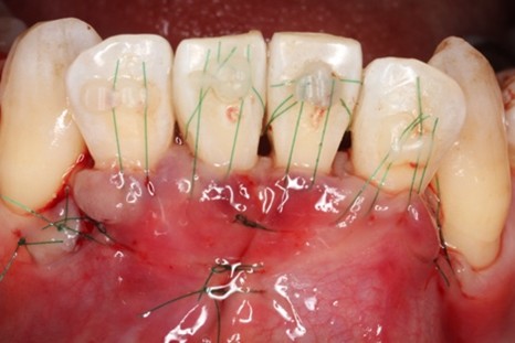 戸越なかやま歯科＋下顎前歯歯肉退縮に対する歯肉移植術＋手術中の症例