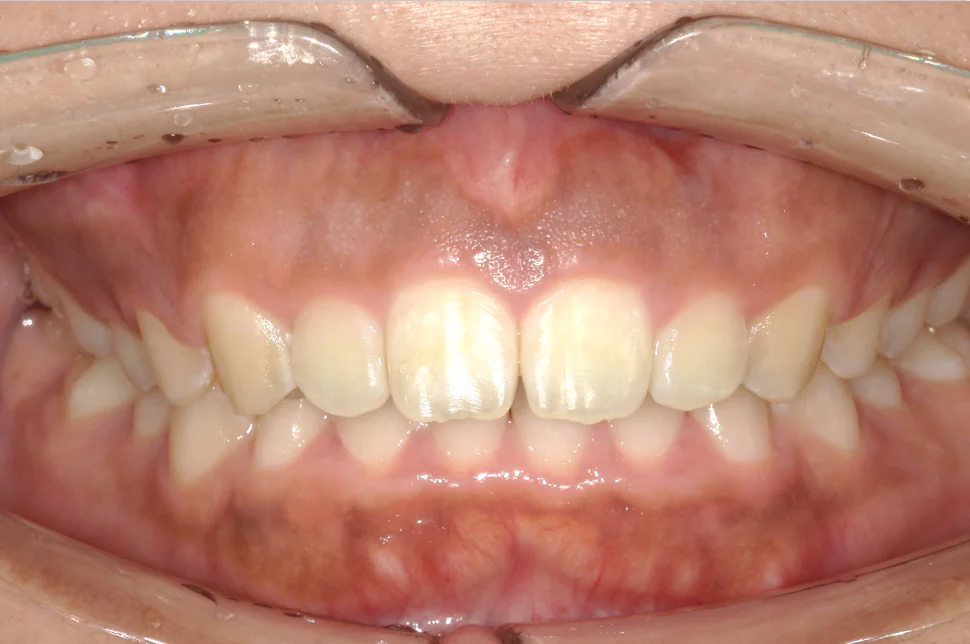 ひまわり歯科矯正歯科 部分矯正⑥ after 正面