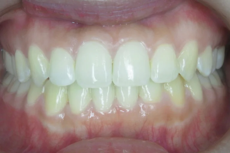 ひまわり歯科矯正歯科 全顎矯正④ after 正面