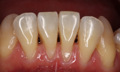 戸越なかやま歯科＋下顎前歯歯肉退縮に対する歯肉移植術＋before