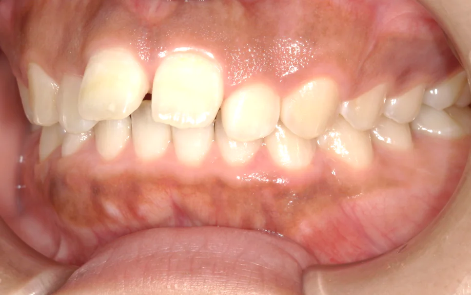 ひまわり歯科矯正歯科 部分矯正⑥ before 左側面