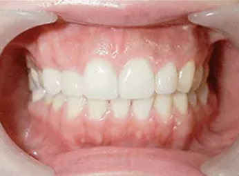 ロイヤル歯科クリニック代々木＋E-maxクラウン＋after