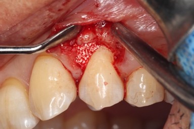 戸越なかやま歯科＋Er:YAGレーザーを併用した歯周組織再生療法＋手術中