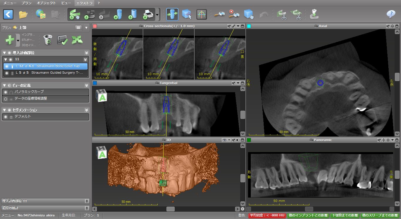 おぎの歯科医院 インプラント治療② 治療中