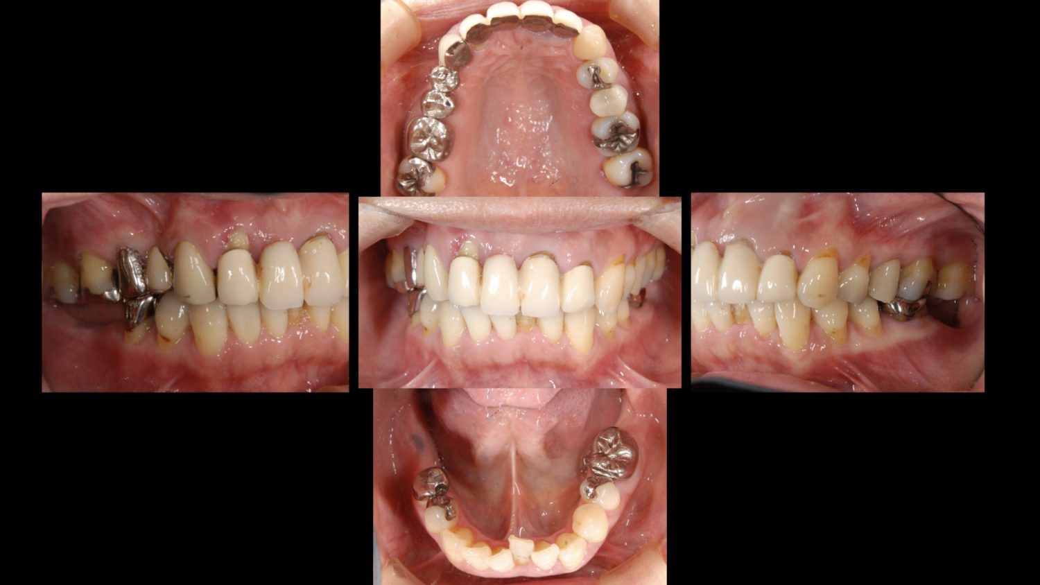 おぎの歯科医院 インプラント治療・セラミック治療① before