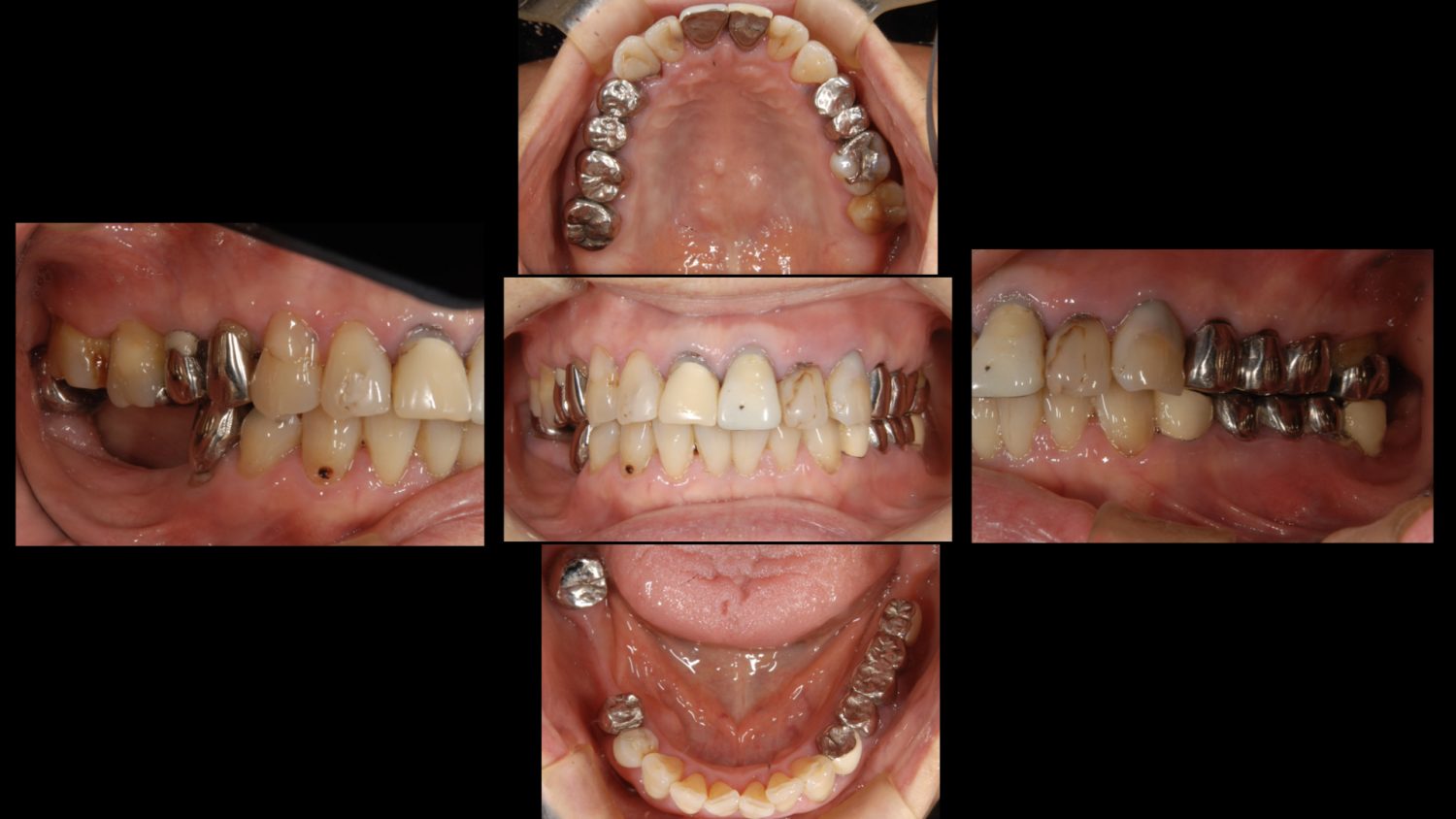 おぎの歯科医院 インプラント治療・セラミック治療② before