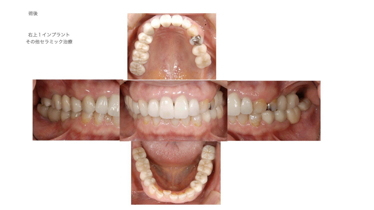 おぎの歯科医院 インプラント治療・セラミック治療④ after