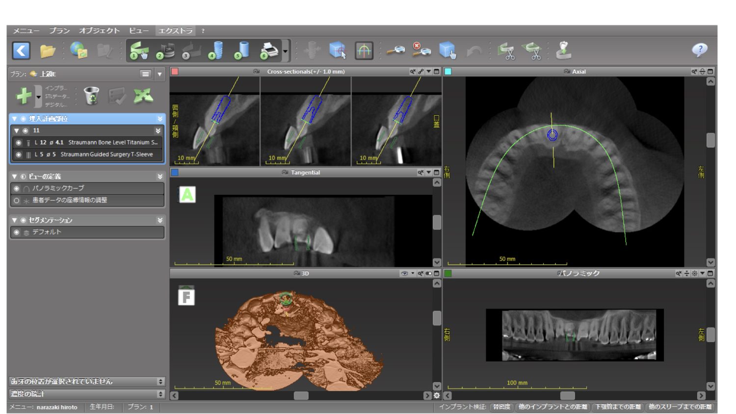 おぎの歯科医院 インプラント治療① 治療中