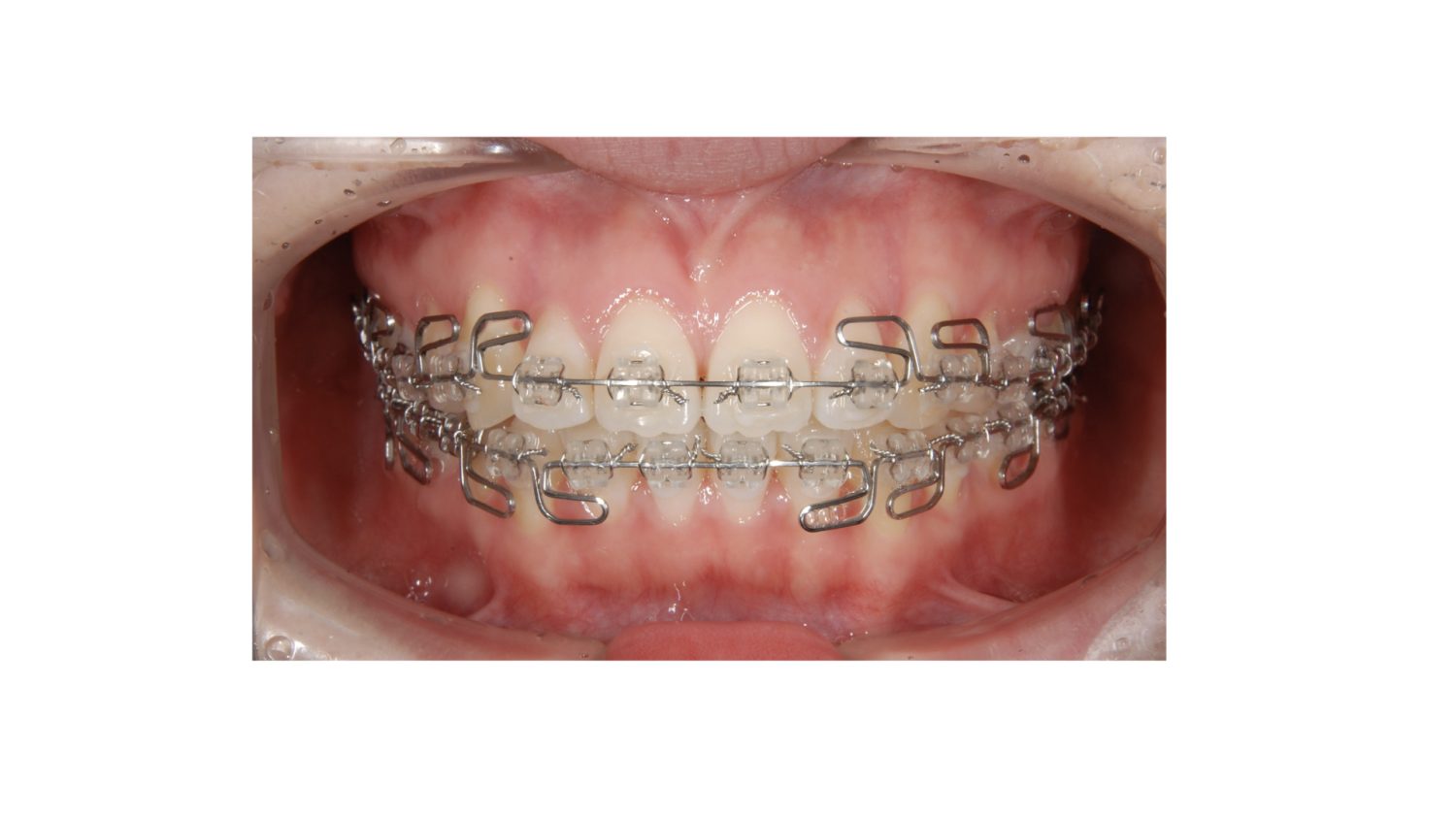 おぎの歯科医院 矯正治療 治療中