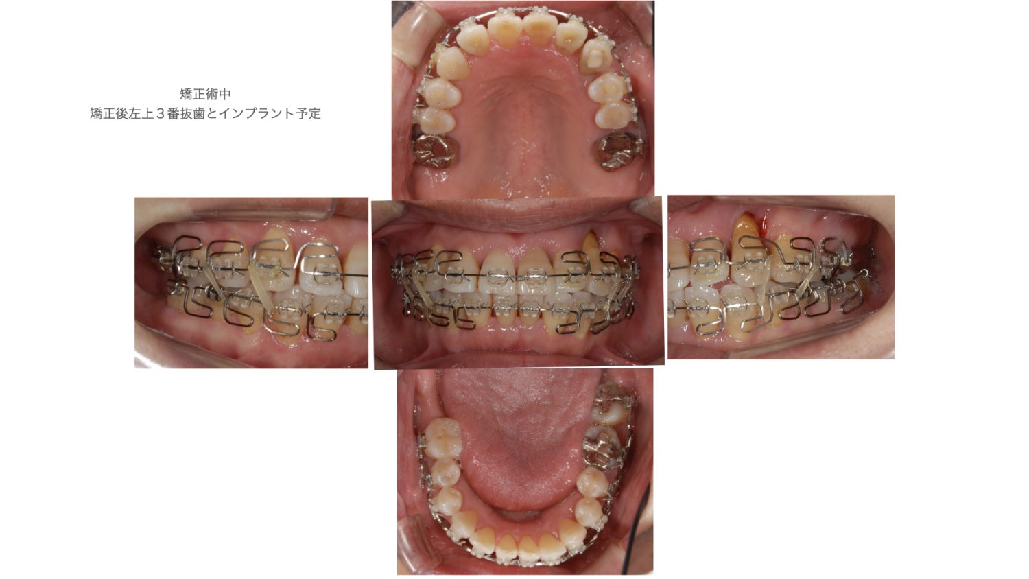 おぎの歯科医院 インプラント治療・矯正治療 治療中