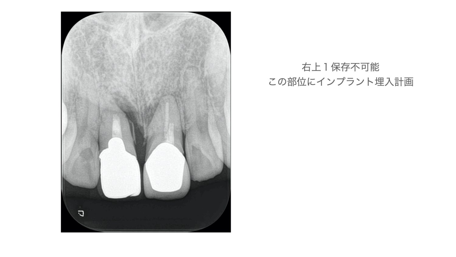 おぎの歯科医院 インプラント治療・セラミック治療③ before