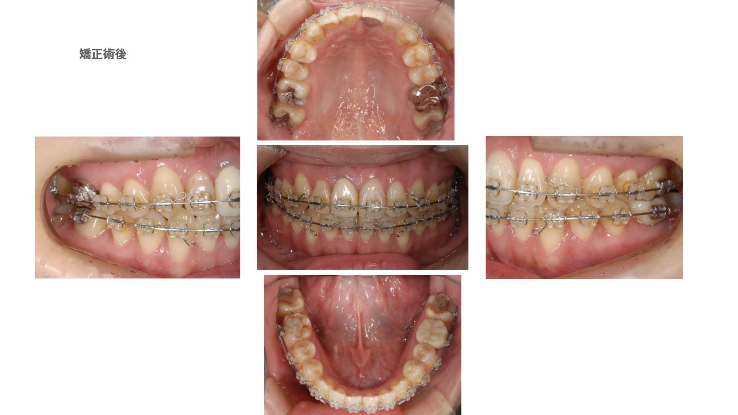 おぎの歯科医院 矯正治療・審美治療の症例紹介 治療中