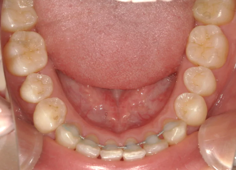 ひまわり歯科矯正歯科 全顎矯正⑤ after 下顎口腔内