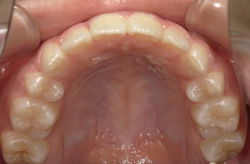 ひまわり歯科矯正歯科 全顎矯正③ after 上顎口腔内