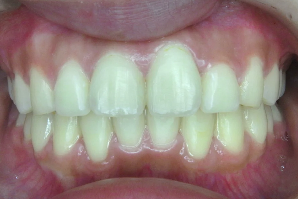 ひまわり歯科矯正歯科 全顎矯正② after 正面