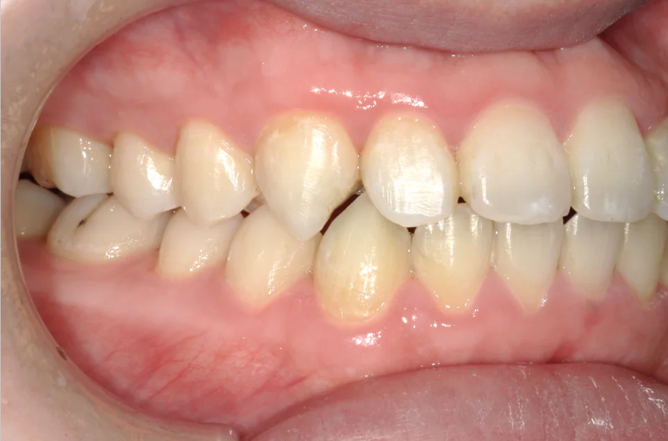 ひまわり歯科矯正歯科 全顎矯正① after 右側面