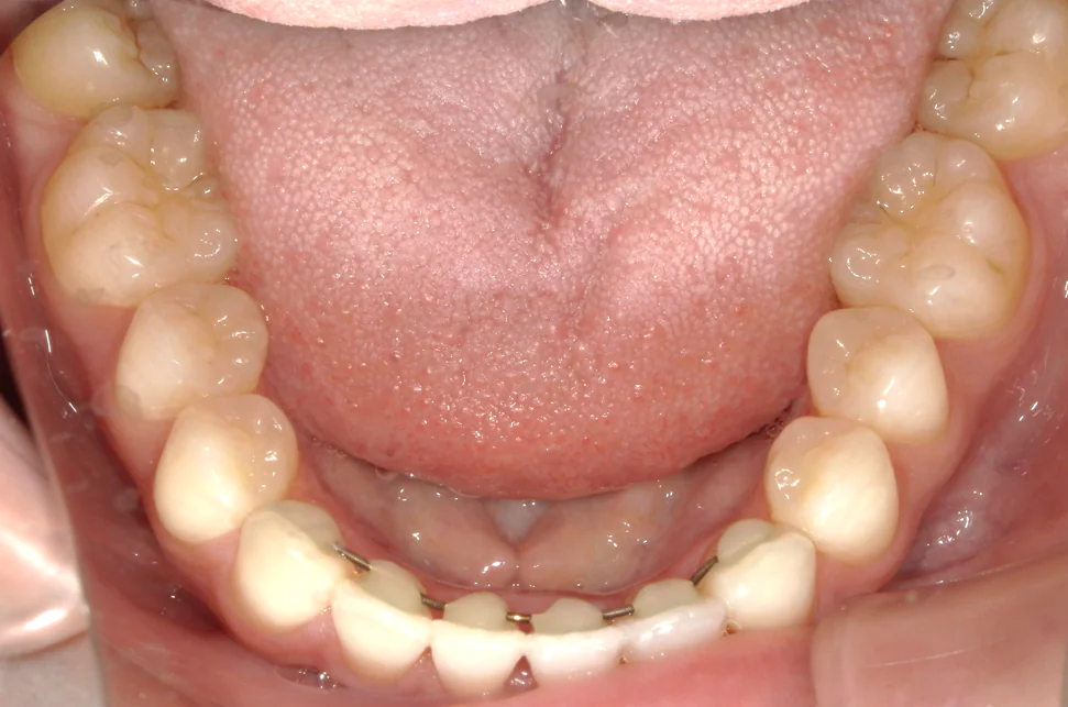 ひまわり歯科矯正歯科 全顎矯正⑥ after 下顎口腔内