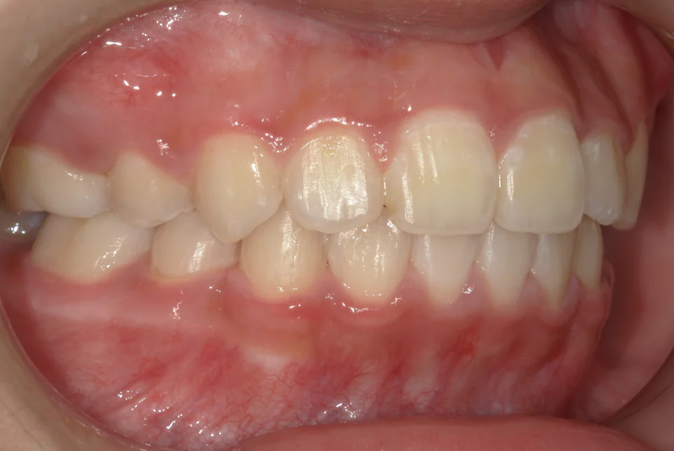 ひまわり歯科矯正歯科 全顎矯正③ after 右側面