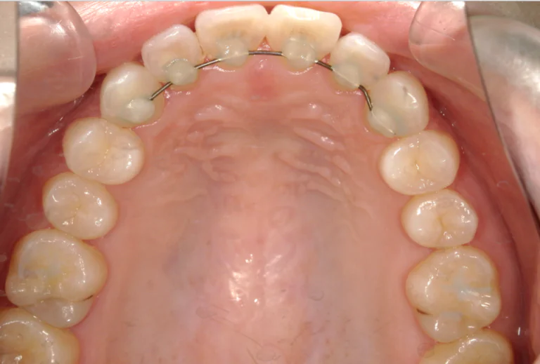 ひまわり歯科矯正歯科 全顎矯正⑥ after 上顎口腔内