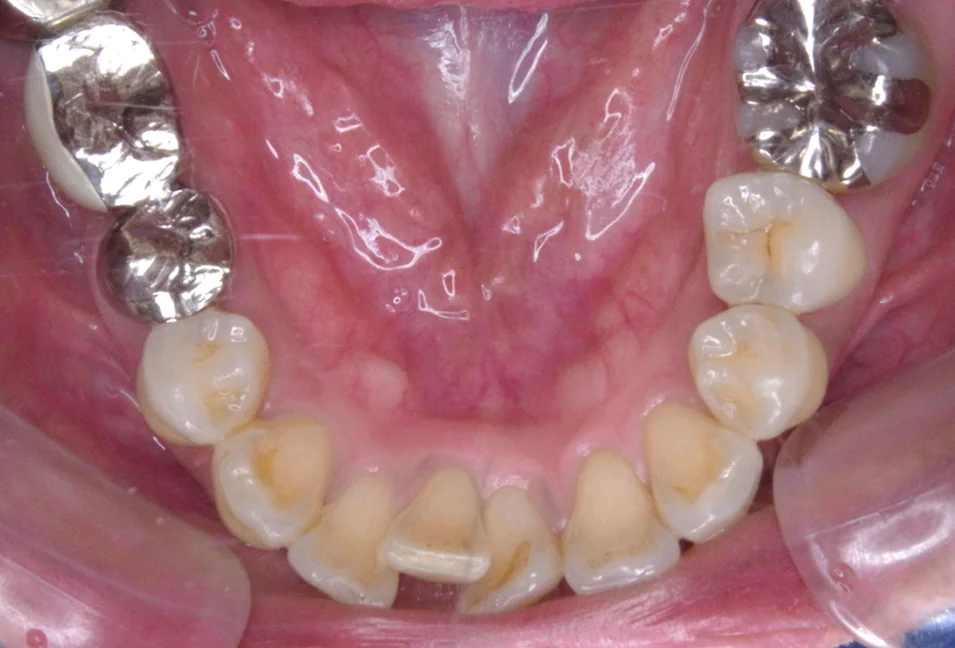 ひまわり歯科矯正歯科 部分矯正② before 下顎口腔内