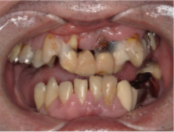 医療法人社団 颯美会 まえだ歯科 南町田グランベリーパーク院オールオン4①before