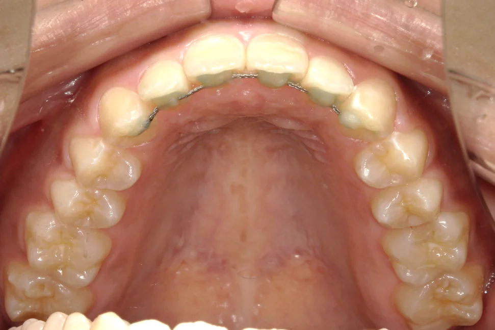 ひまわり歯科矯正歯科 部分矯正⑥ after 上顎口腔内
