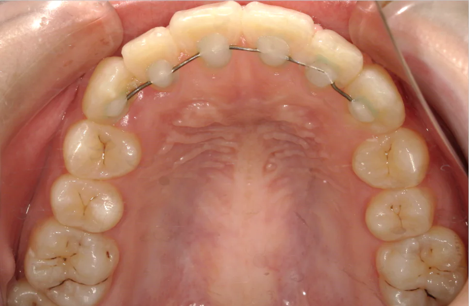 ひまわり歯科矯正歯科 部分矯正① after 上顎口腔内