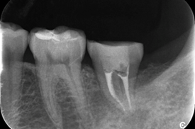 戸越なかやま歯科＋親知らずを移植し咬み合わせを作ったケース＋移植歯の根幹治療終了時