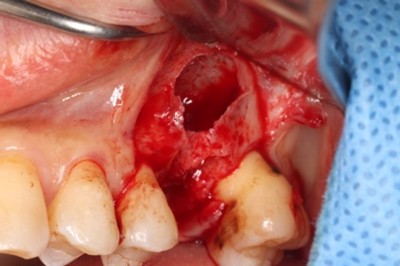 戸越なかやま歯科＋歯根破折した歯に対してRidge Preservationを行いインプラント埋入を行ったケースの症例＋インプラント埋入時