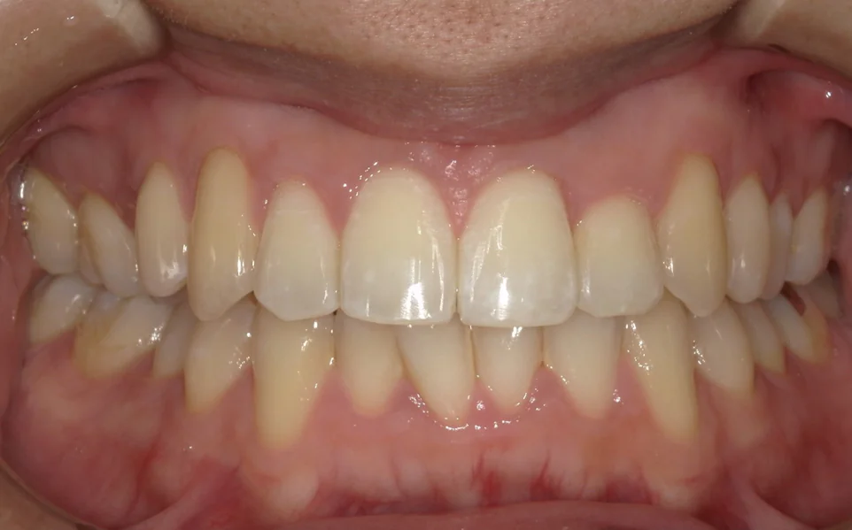 ひまわり歯科矯正歯科 部分矯正⑤ after 正面
