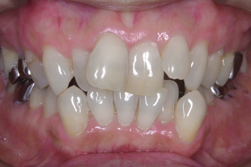 ひまわり歯科矯正歯科 部分矯正② before 正面