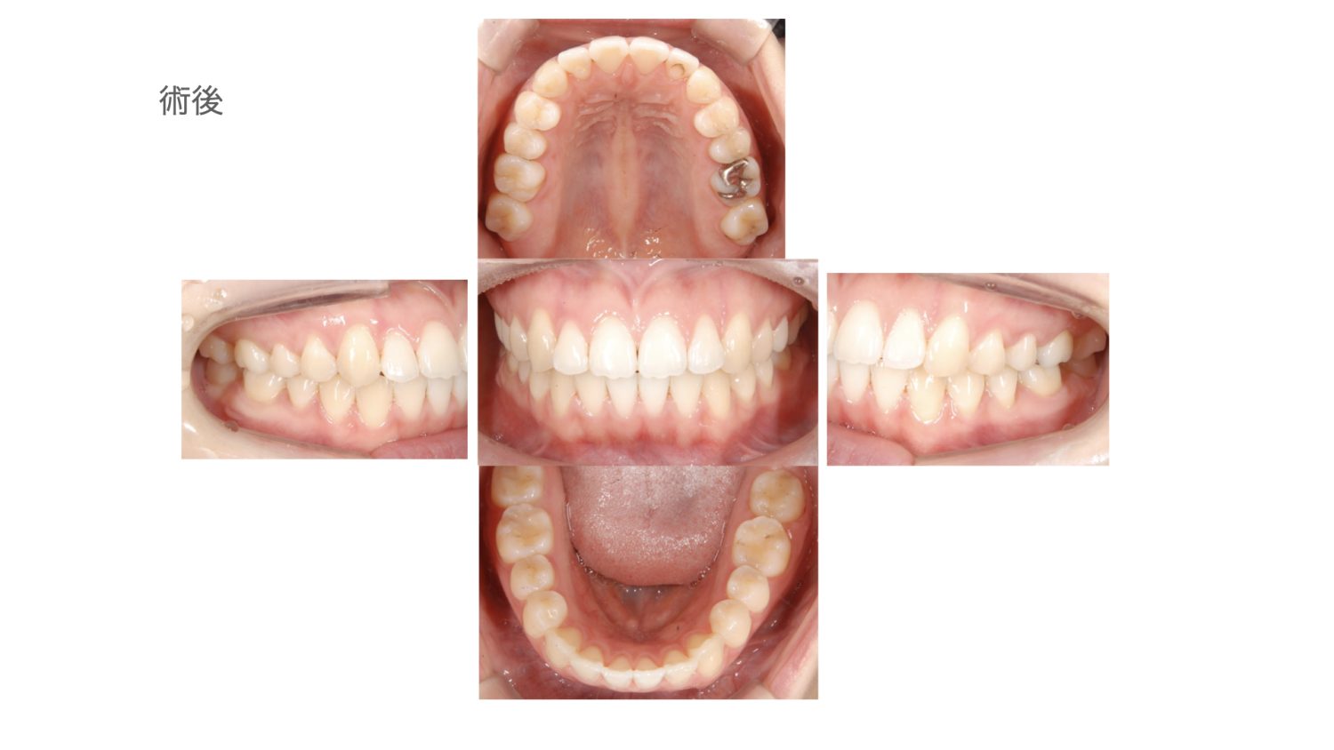 おぎの歯科医院 矯正治療 after