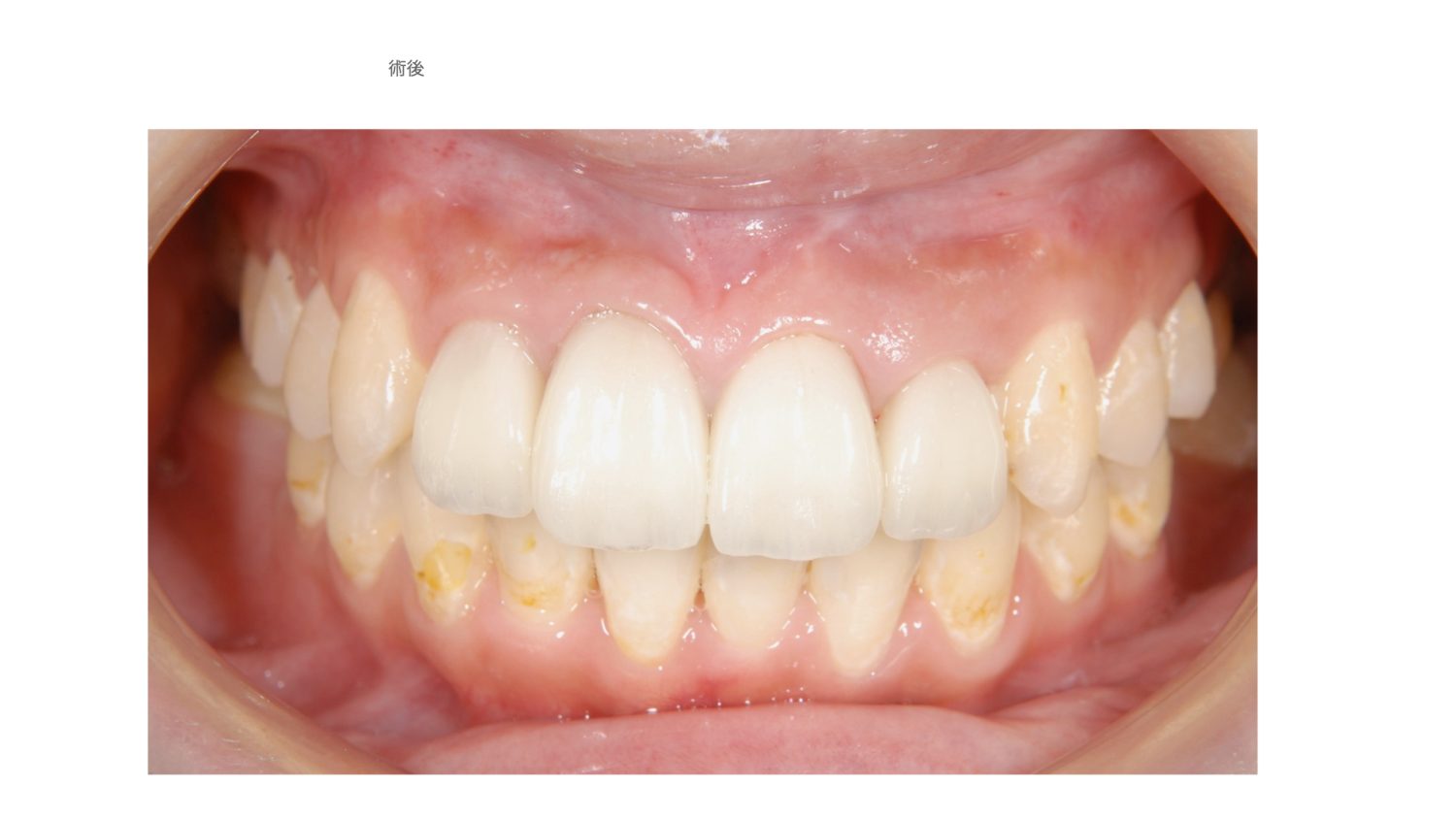 おぎの歯科医院 根管治療・矯正治療・補綴治療 after