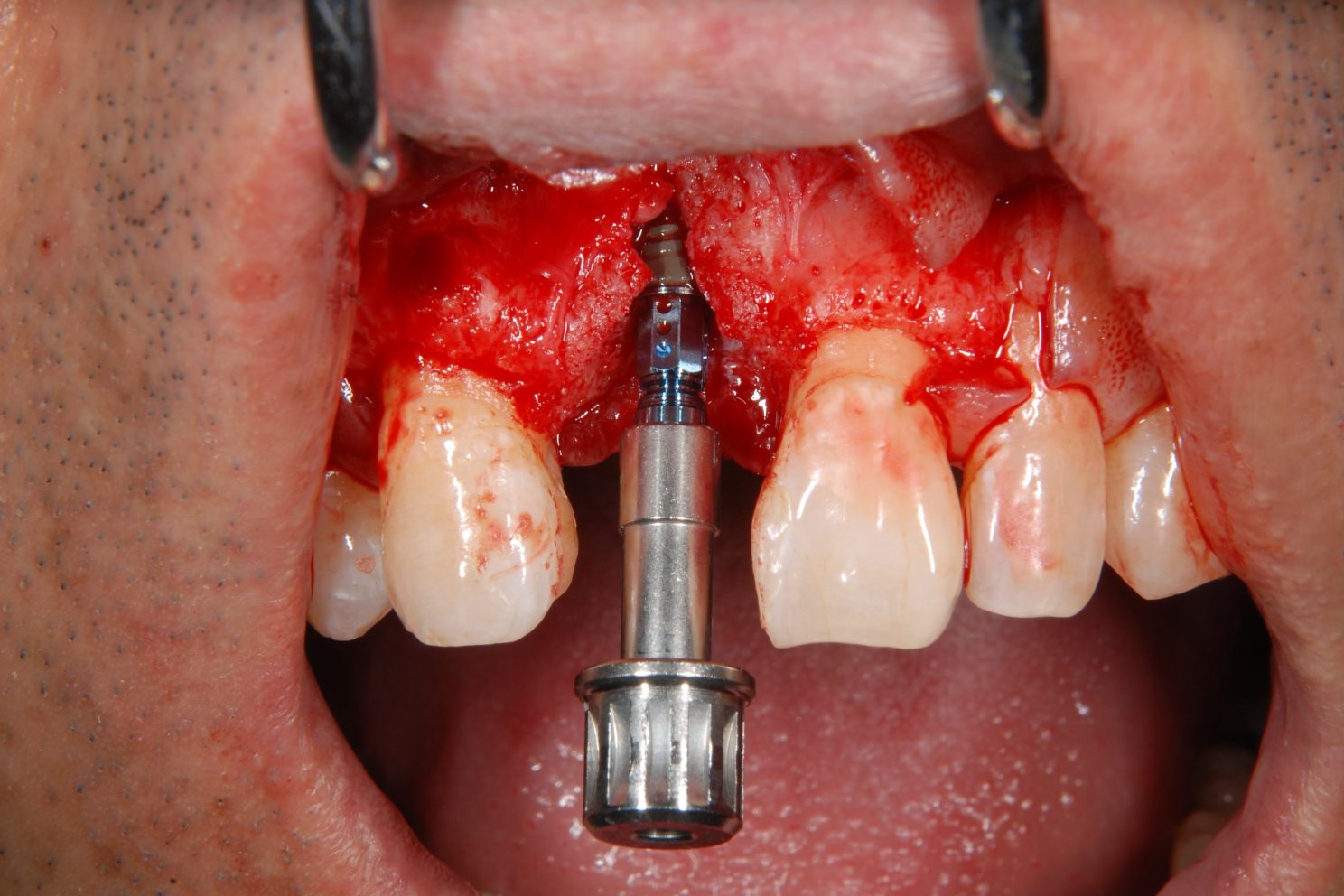 おぎの歯科医院 インプラント治療② 治療中