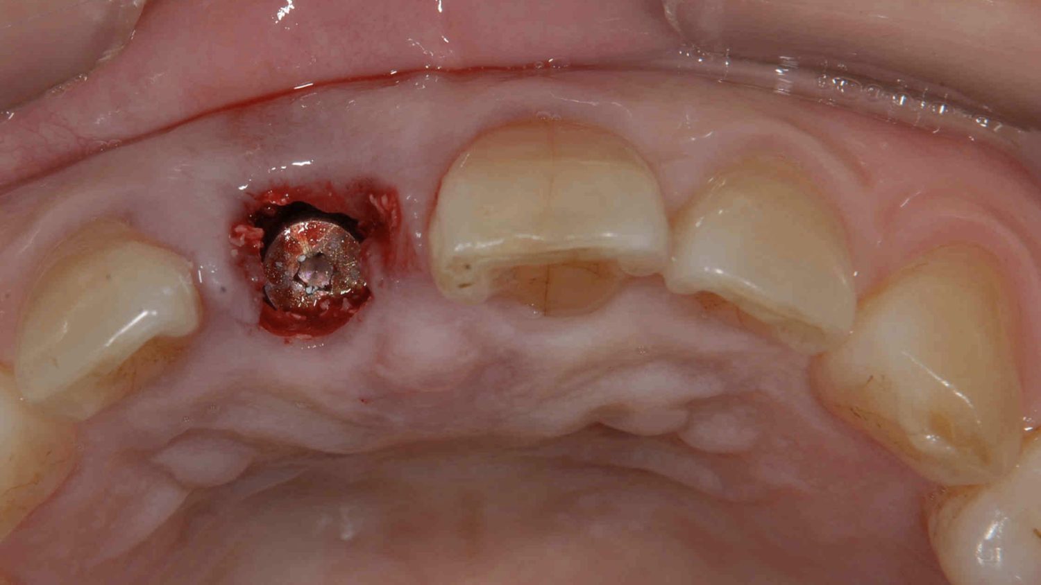 おぎの歯科医院 インプラント治療① 治療中