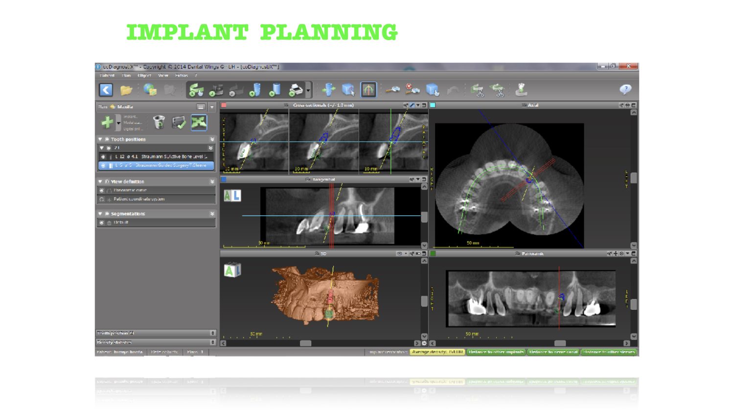 おぎの歯科医院 インプラント治療・矯正治療 治療中