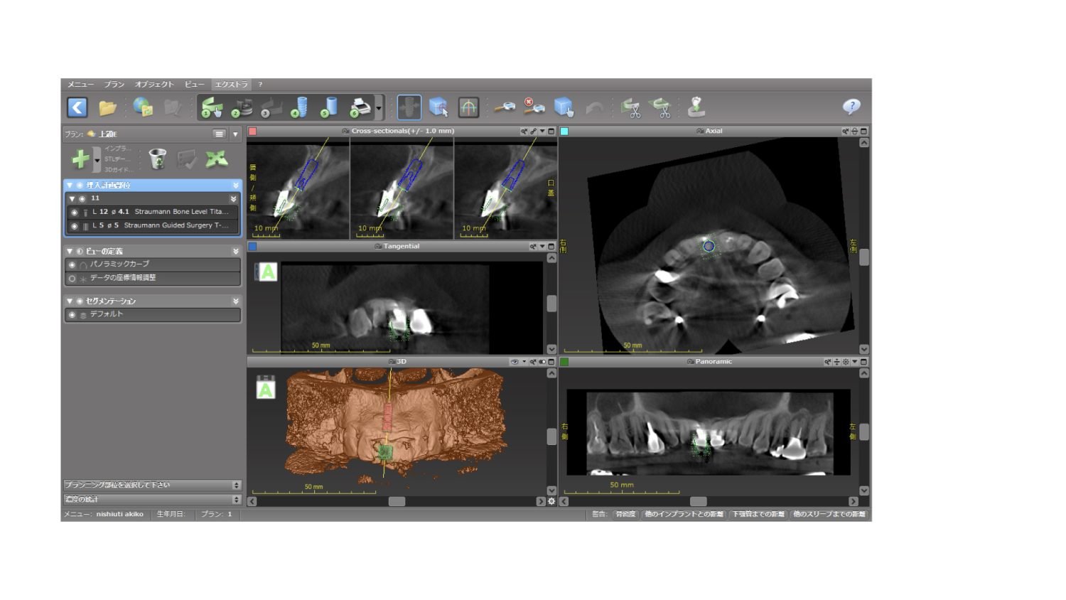 おぎの歯科医院 インプラント治療・セラミック治療③ before