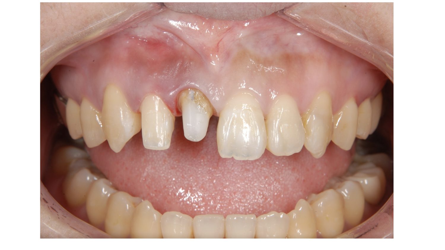 おぎの歯科医院 矯正治療・審美治療の症例紹介 治療中