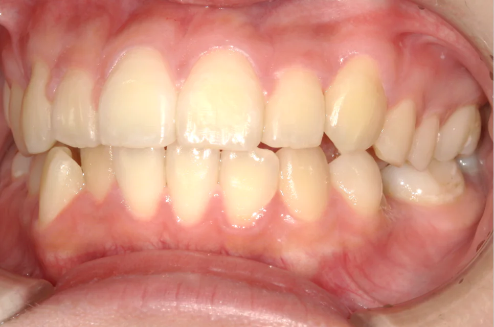 ひまわり歯科矯正歯科 部分矯正① after 左側面