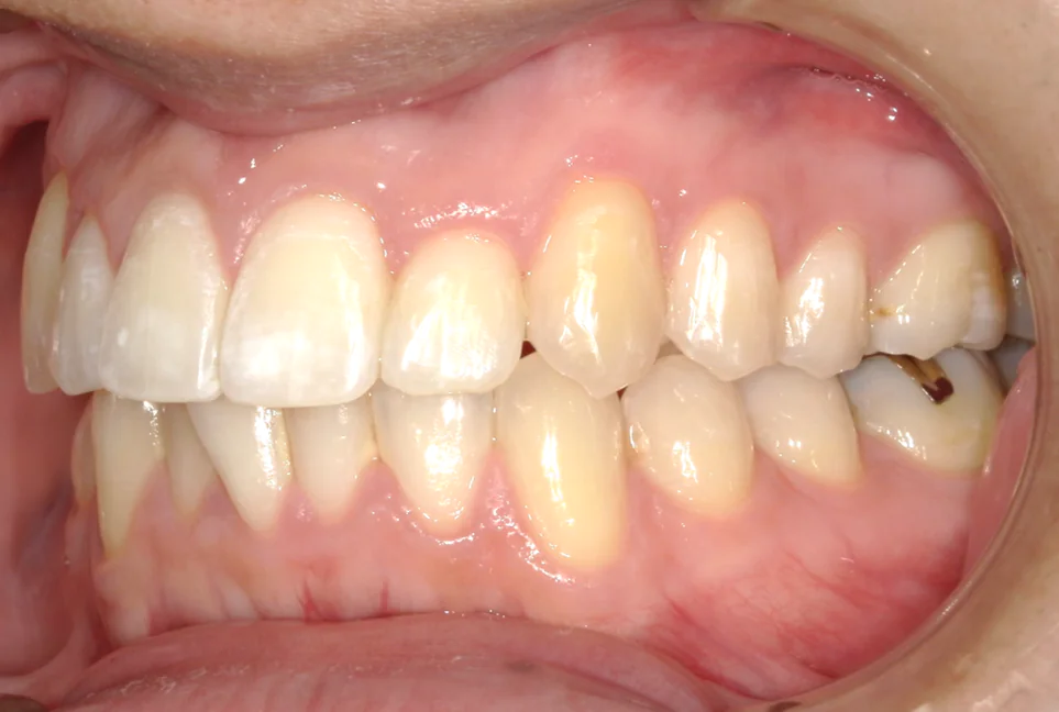 ひまわり歯科矯正歯科 部分矯正⑤ after 左側面