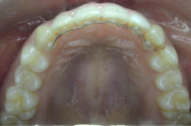 ひまわり歯科矯正歯科 全顎矯正④ after 上顎口腔内