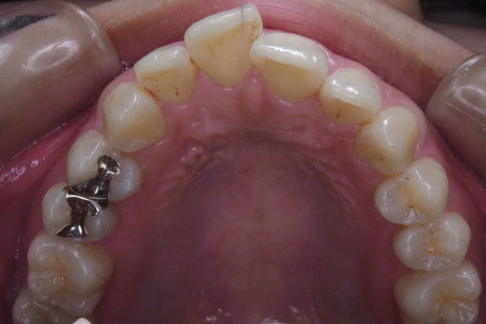 ひまわり歯科矯正歯科 全顎矯正⑤ before 上顎口腔内