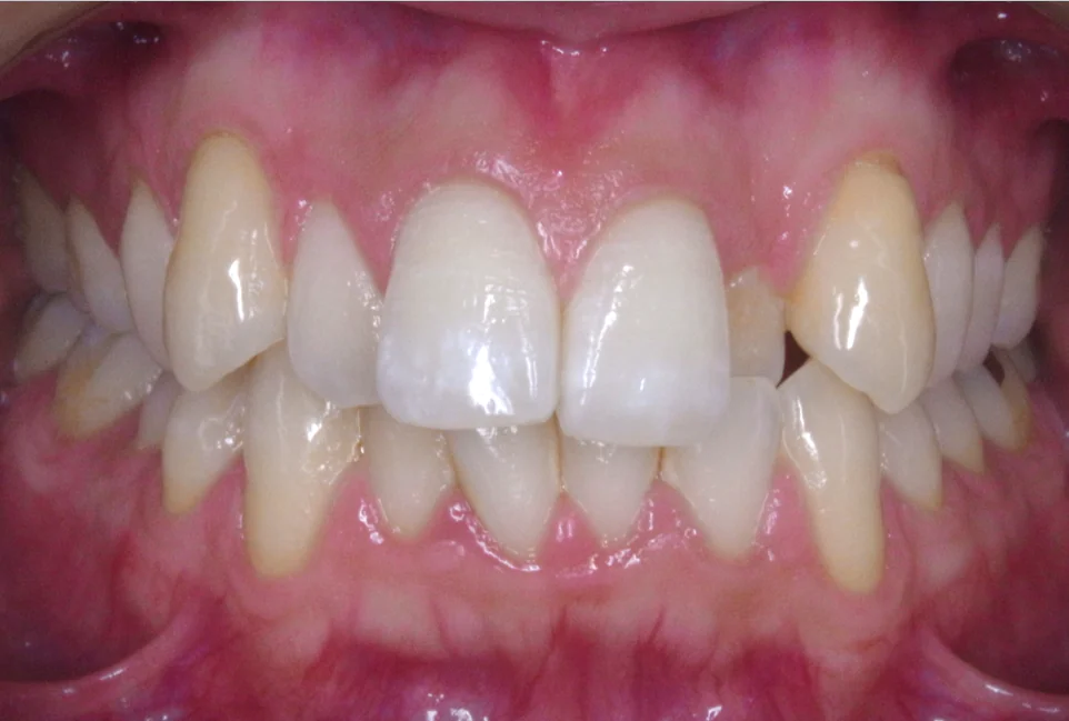 ひまわり歯科矯正歯科 部分矯正⑤ before 正面